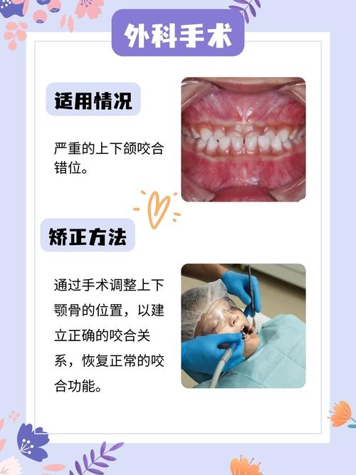 牙齿咬合错位矫正方法有哪些?-图2 牙齿咬合错位矫正方法有哪些?-图2