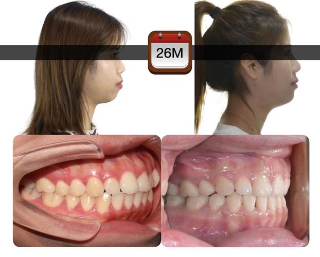 18岁矫正牙齿还来得及吗？-图2