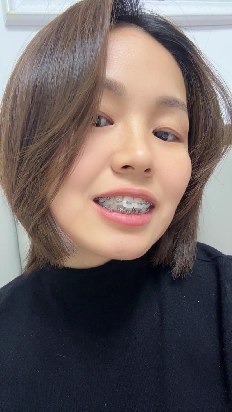 32岁矫正牙齿还来得及吗？成年人矫正可行吗？-图1