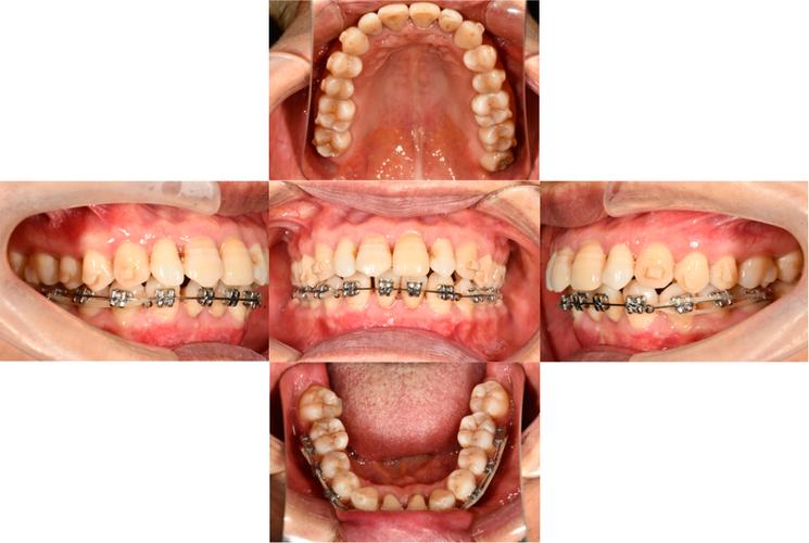 牙周炎能矫正牙齿吗？-图3