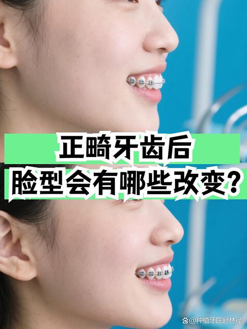 牙齿矫正会有什么影响？效果与潜在风险如何兼顾？-图2