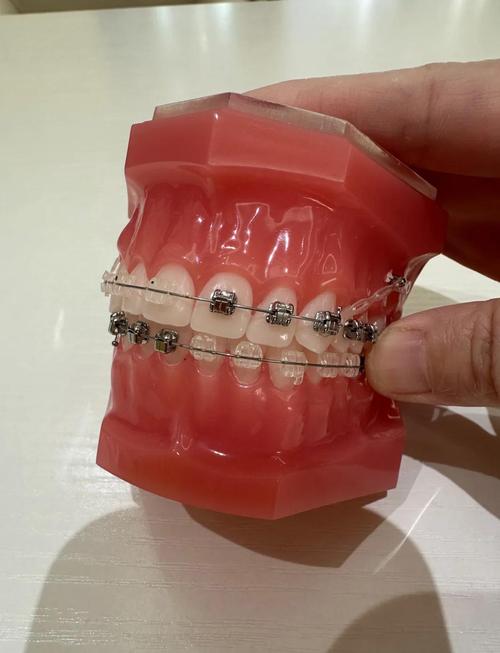 网上牙齿矫正器效果如何？真的有用吗？-图1