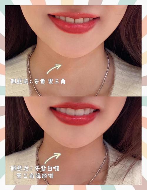 网上牙齿矫正器效果如何？真的有用吗？-图3