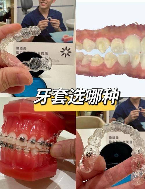 隐形牙齿矫正器有用吗?效果到底行不行?-图1 隐形牙齿矫正器有用吗?效果到底行不行?-图1