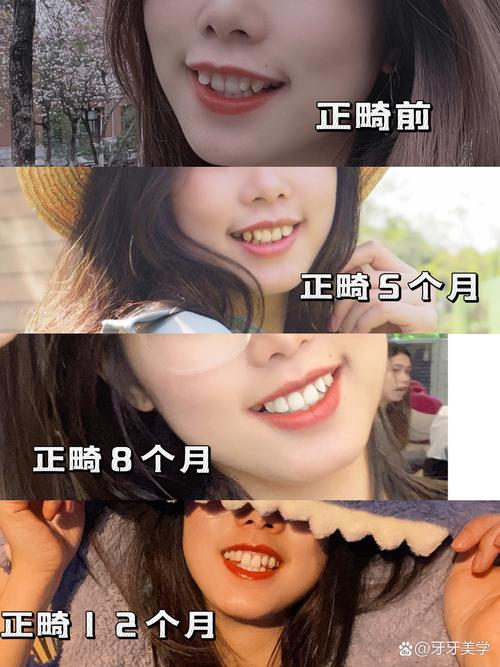 20岁矫正牙齿还来得及吗?成年人矫正来得及吗?-图3 20岁矫正牙齿还来得及吗?成年人矫正来得及吗?-图3