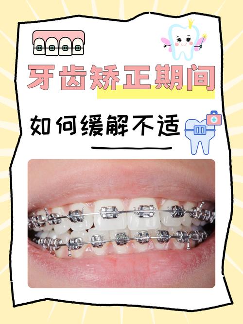 不戴牙套怎么矫正牙齿-图3 不戴牙套怎么矫正牙齿-图3