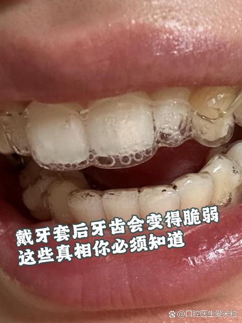 牙齿矫正可能带来哪些后遗症？矫正前必知的健康隐患？-图3