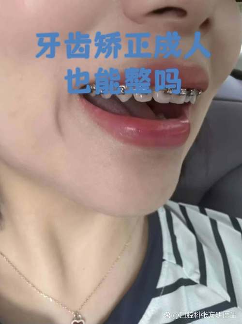成年人矫正牙齿，真的可以吗？会有哪些影响和注意事项？-图2