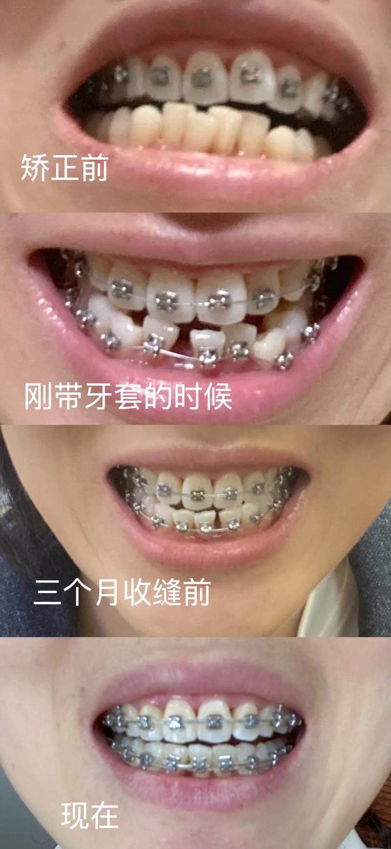 成年人矫正牙齿，真的可以吗？会有哪些影响和注意事项？-图3