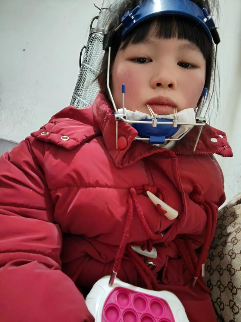 地包天牙齿矫正多少钱-图3 地包天牙齿矫正多少钱-图3