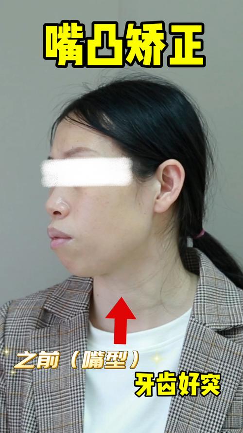 38岁矫正牙齿的后果-图1