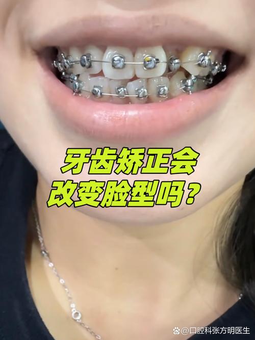 矫正牙齿到底能不能改变脸型？-图1