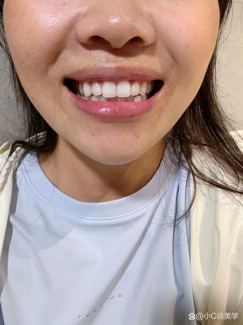 20岁矫正牙齿晚不晚？现在开始还来得及吗？-图1