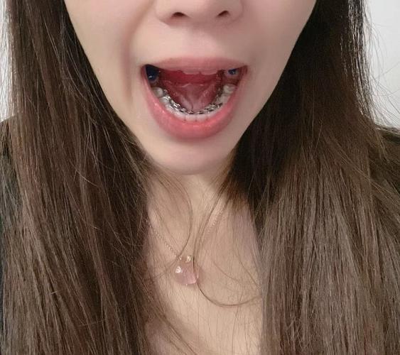 矫正牙齿后，侧面会变好看吗？-图3