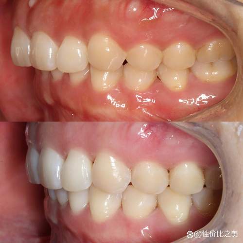 矫正牙齿后咬合不了，是什么原因导致的？-图3