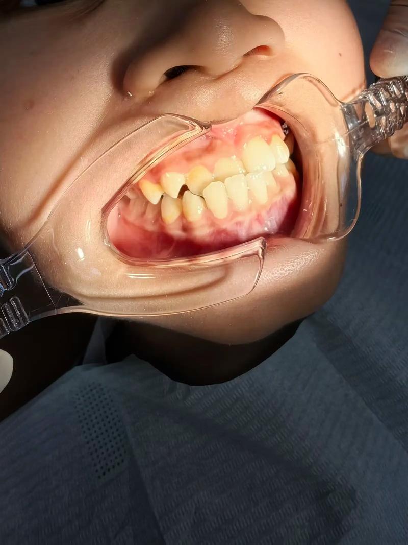 矫正牙齿后咬合不了，是什么原因导致的？-图2