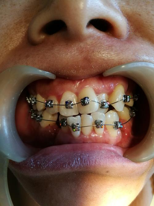 合肥口腔牙齿矫正效果如何?价格贵不贵?靠谱吗?-图2 合肥口腔牙齿矫正效果如何?价格贵不贵?靠谱吗?-图2