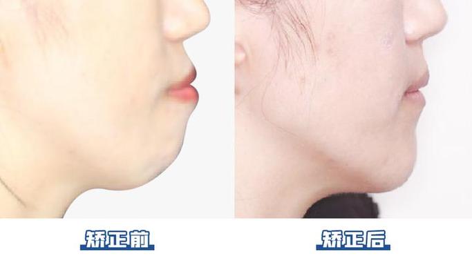 北京301医院牙齿矫正效果怎么样？价格贵吗？-图2