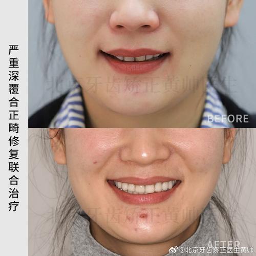 北京301医院牙齿矫正效果怎么样？价格贵吗？-图3