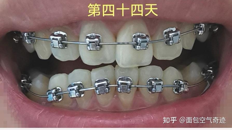光华口腔矫正牙齿效果怎么样？好不好做？价格贵不贵？-图3