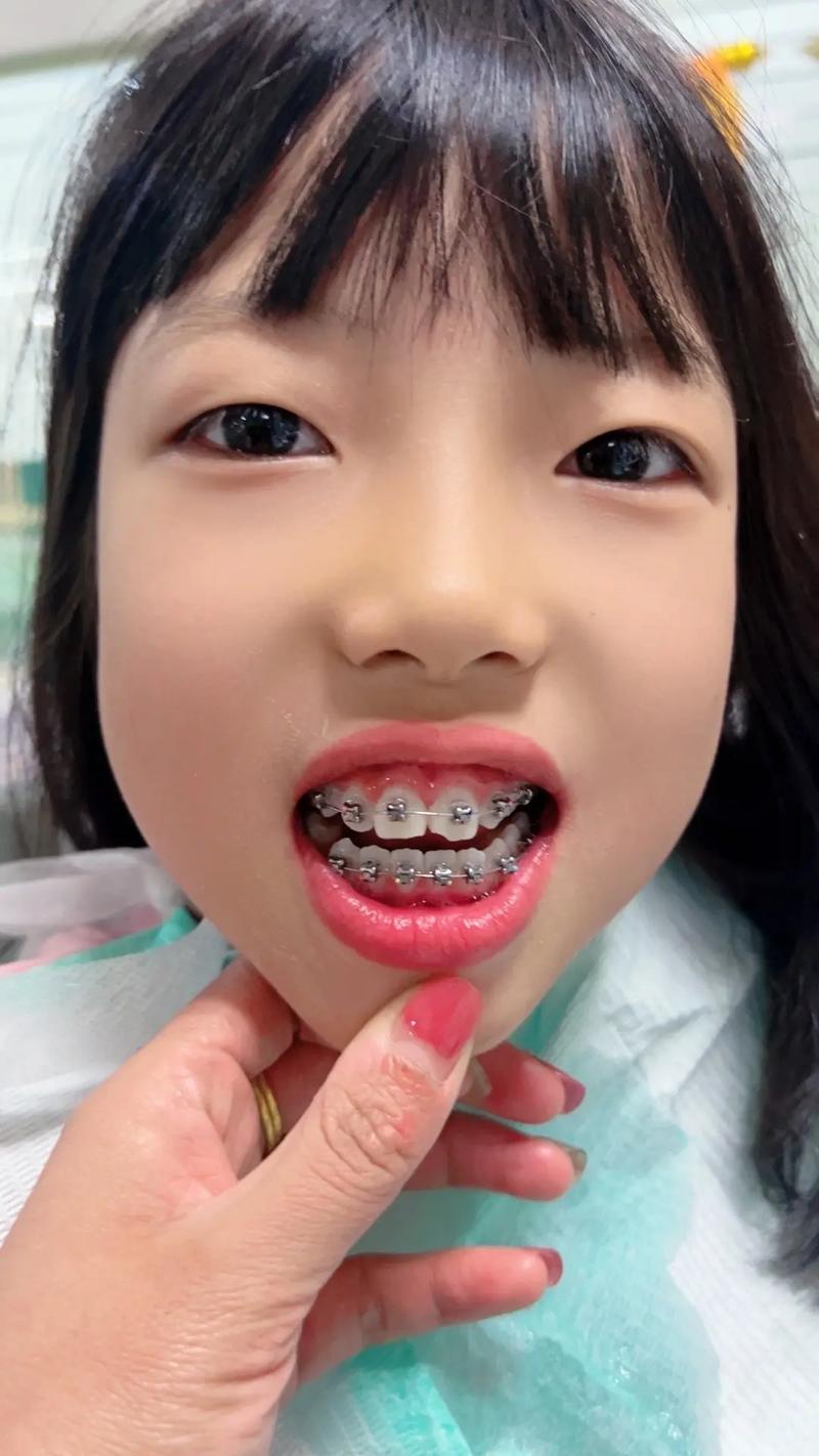 孩子牙齿矫正效果如何？能维持多久？有哪些影响因素？-图1