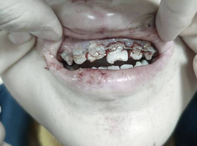 牙齿矫正托槽部分掉落，是什么原因导致的？-图2