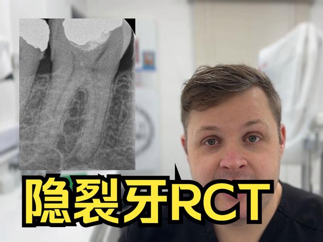 牙齿矫正会导致牙隐裂吗?图片解析原因与应对-图1 牙齿矫正会导致牙隐裂吗?图片解析原因与应对-图1