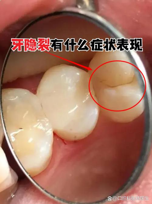 牙齿矫正会导致牙隐裂吗?图片解析原因与应对-图2 牙齿矫正会导致牙隐裂吗?图片解析原因与应对-图2