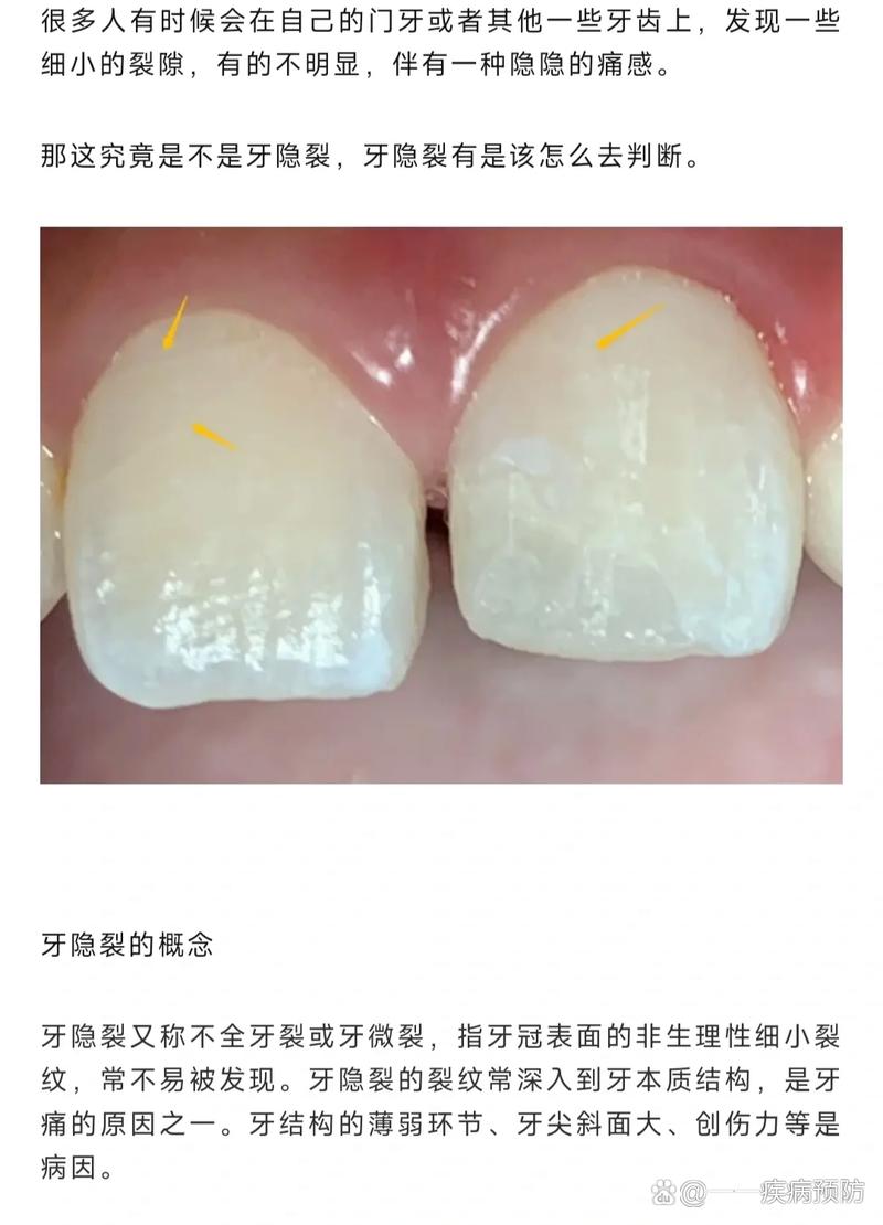 牙齿矫正会导致牙隐裂吗?图片解析原因与应对-图3 牙齿矫正会导致牙隐裂吗?图片解析原因与应对-图3