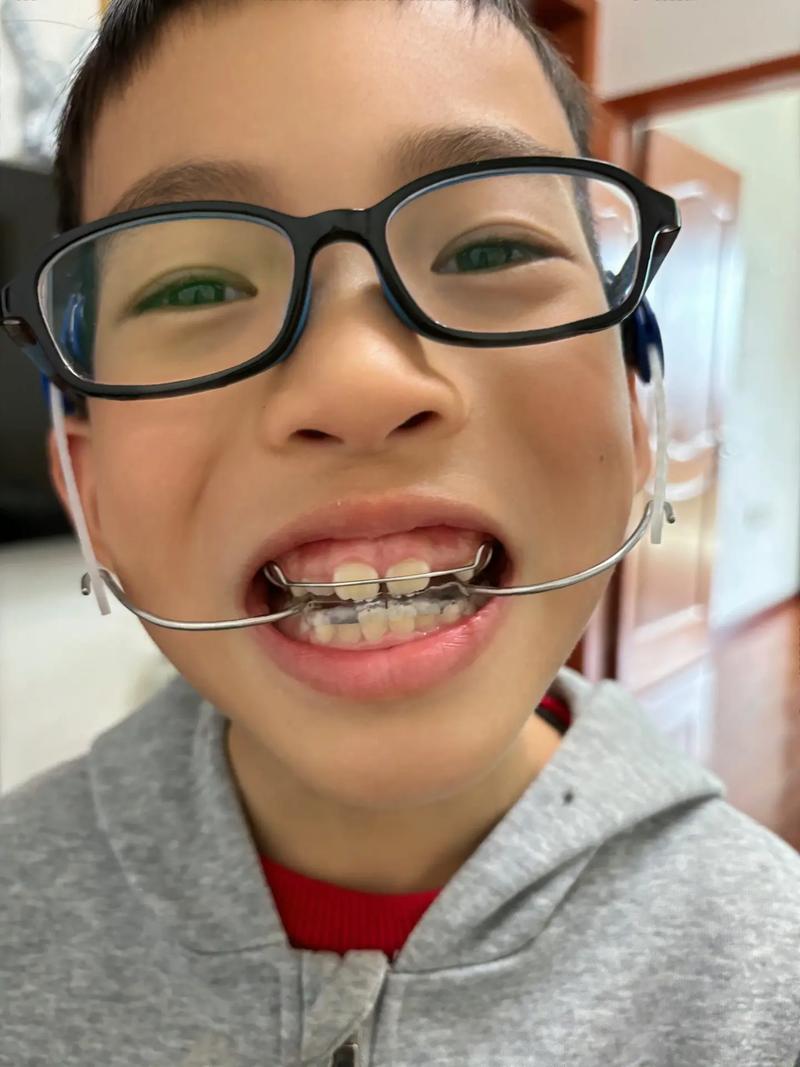 小孩矫正牙齿 痛苦-图1