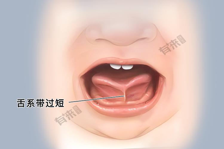 舌系带 牙齿 矫正-图1
