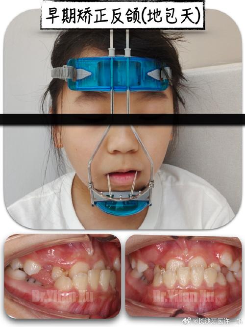 舌系带 牙齿 矫正-图3