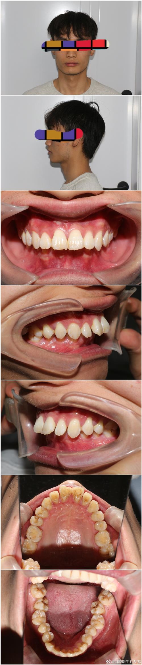 牙齿矫正会让嘴后移吗？原因是什么？-图3