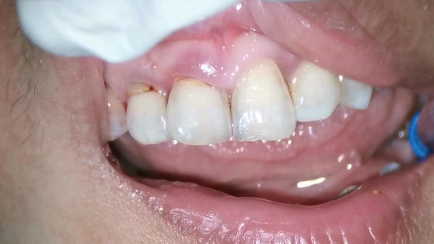 矫正牙齿会导致牙根裸露吗？原因和应对方法是什么？-图1