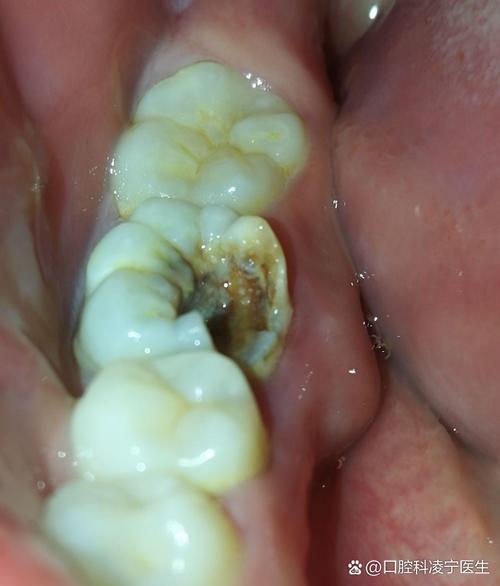 矫正牙齿会导致牙根裸露吗？原因和应对方法是什么？-图2