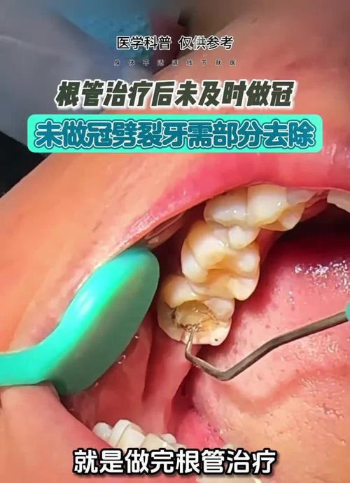 牙齿矫正会导致牙根断裂吗?断裂后还能继续矫正吗?-图3 牙齿矫正会导致牙根断裂吗?断裂后还能继续矫正吗?-图3