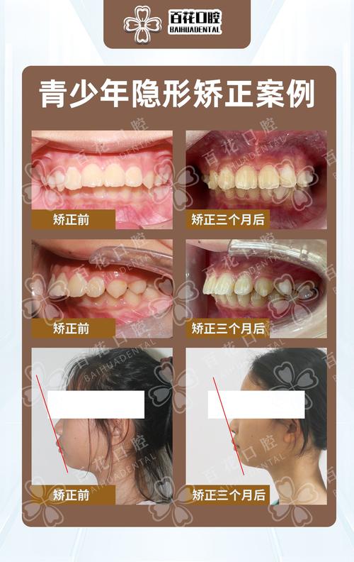 温州 隐形牙齿矫正-图2