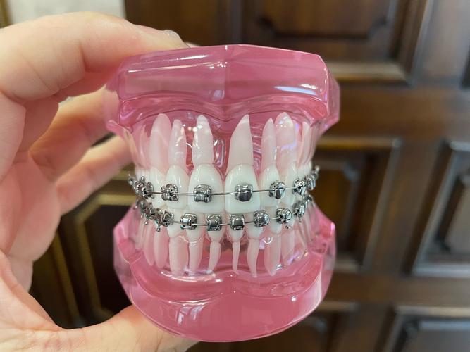 牙齿矫正用冰晶托槽效果真的更好吗?-图2 牙齿矫正用冰晶托槽效果真的更好吗?-图2
