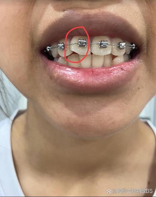 牙齿矫正后牙齿酸痛，是正常现象吗？怎么缓解？-图3