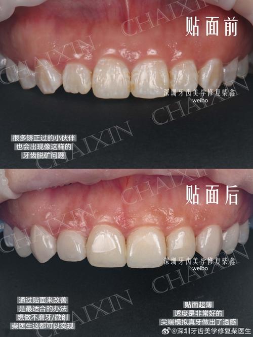 牙齿矫正会引发牙齿脱矿吗？-图1