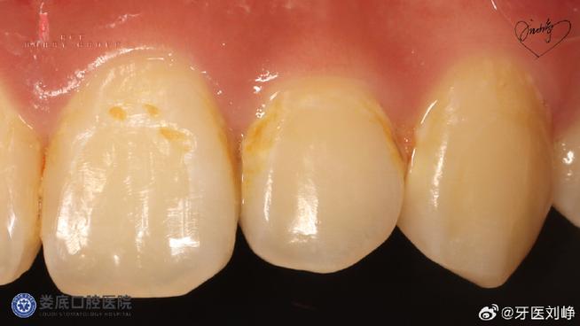 牙齿矫正会引发牙齿脱矿吗？-图2