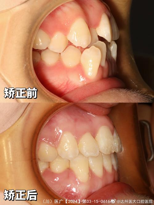 牙齿美白和矫正，该先做哪个更有效？-图3