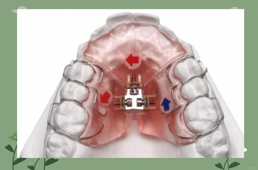 牙齿功能矫正器与传统矫正器功能差异在哪?-图1 牙齿功能矫正器与传统矫正器功能差异在哪?-图1