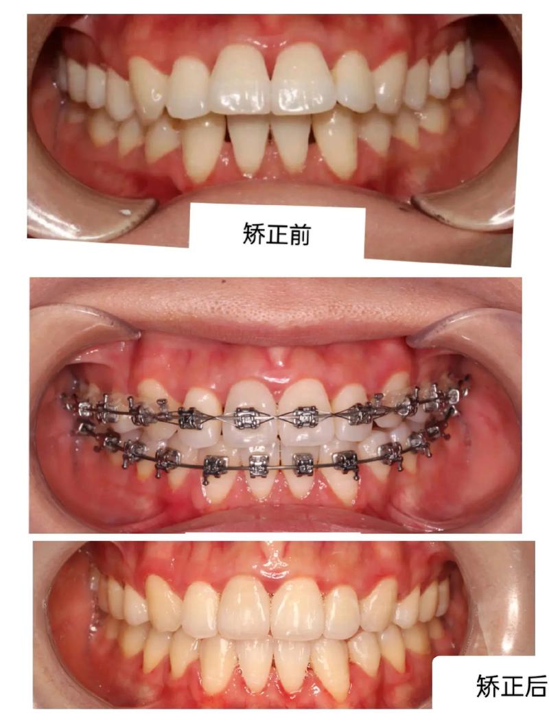 齿鄂矫正和牙齿矫正-图1