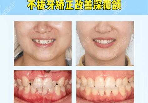 齿鄂矫正和牙齿矫正-图3