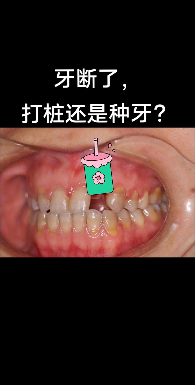 牙齿打桩能矫正牙齿吗？打桩矫正安全有效吗？-图2