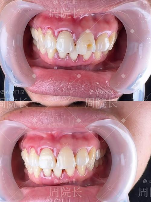 矫正牙齿和牙齿贴面-图1