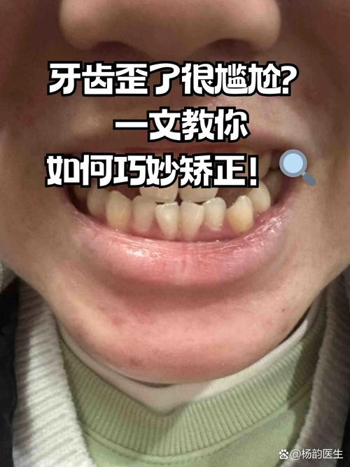 歪牙矫正效果如何？能让牙齿彻底变整齐吗？-图2