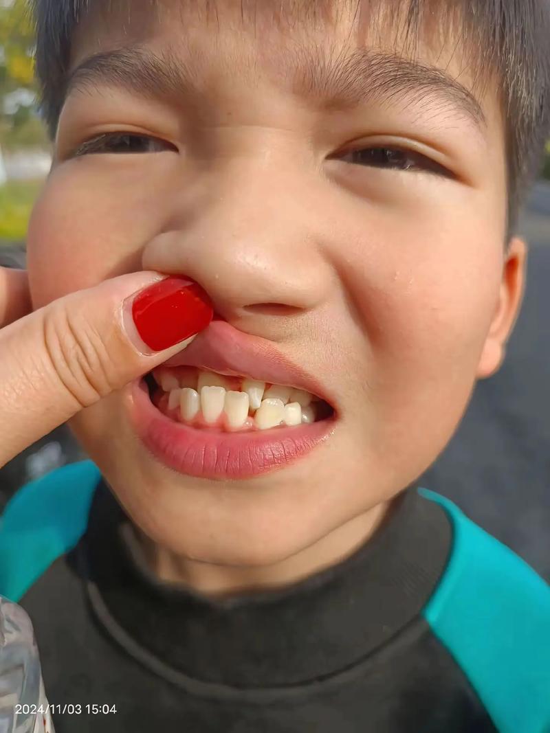 歪牙矫正效果如何？能让牙齿彻底变整齐吗？-图3