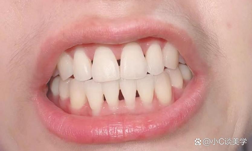 矫正牙齿后牙齿根部发黑，是什么原因？该如何处理？-图1